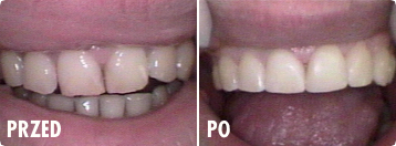 Stomatologia estetyczna - korekcja kształtu zęba przy użyciu korony porcelanowej