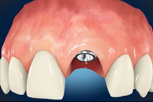 Wprowadzenie implantu korzenia zębowego