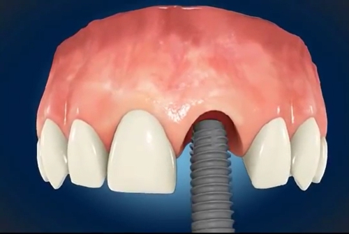 Wkręcanie implantu zębowego