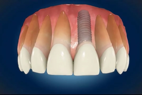 Specjalistyczna implantologia w gabinecie Dental Care Konin