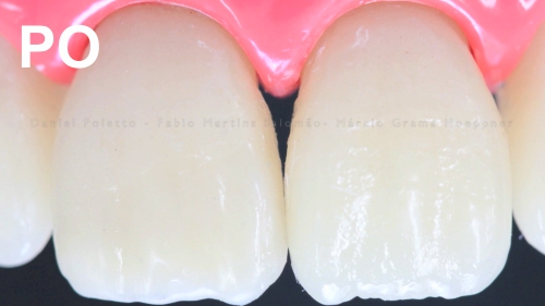 Ząb po zabiegu rekonstrukcji stomatologii estetycznej
